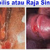 penyakit sipilis ATAU raja singa