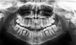 KLINIK PERGIGIAN SYARIFAH: Berapa Kerapkah Gigi Harus Di X-Ray