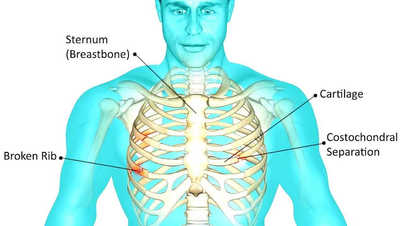 Rib Cartilage Injury Masnad Health Clinic vrogue.co