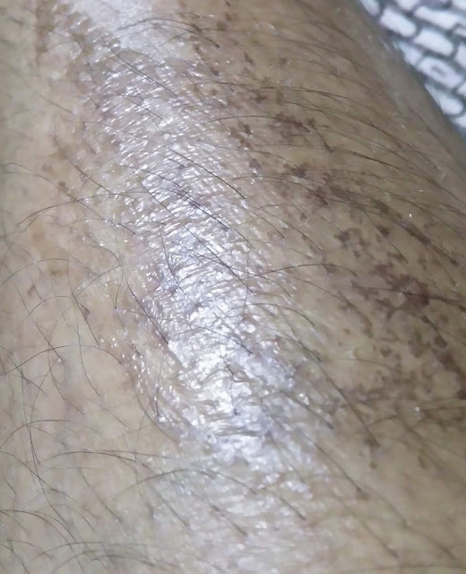 skin peeling after 35% TCA peel