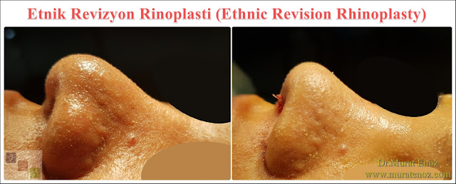Ethnic Rhinoplasty Istanbul – Nose job in Istanbul – Nose surgery in Istanbul – Nose job in Turkey - Ethnic rhinoplasty Turkey - Ethnic rhinoplasty in Turkey - African American rhinoplasty - Ethnic expert nose job surgeon - Rhinoplasty surgeon in Istanbul - Black nose job - Rhinoplasty for ethnic nose - Rhinoplasty for African people - African American nose surgery – Rhinoplasty for African American Nose - Thick skin rhinoplasty - Rhinoplasty in istanbul Ethnic Rhinoplasty Istanbul – Nose job in Istanbul – Nose surgery in Istanbul – Nose job in Turkey - Ethnic rhinoplasty Turkey - Ethnic rhinoplasty in Turkey - African American rhinoplasty - Ethnic expert nose job surgeon - Rhinoplasty surgeon in Istanbul - Black nose job - Rhinoplasty for ethnic nose - Rhinoplasty for African people - African American nose surgery – Rhinoplasty for African American Nose - Thick skin rhinoplasty - Rhinoplasty in istanbul
