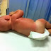 Bebê de cinco meses sofre graves queimaduras após exposição ao sol