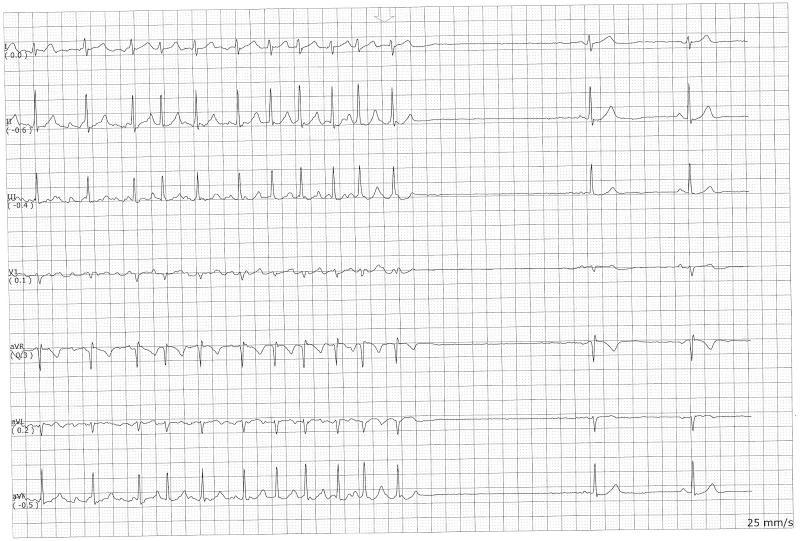 Float Nurse Multifocal Atrial Tachycardia with Sinus Arrest