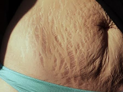 When stretch marks become embarrassing...then you need this natural and