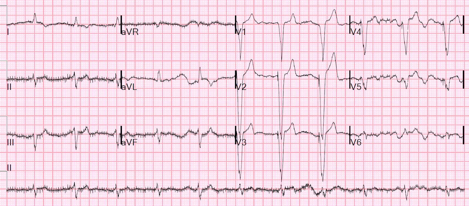 Dr. Smith's ECG Blog Computer often fails to diagnose atrial