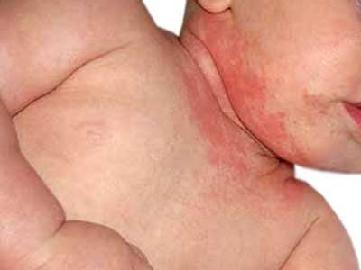 Image result for cara menghilangkan ruam kulit pada bayi