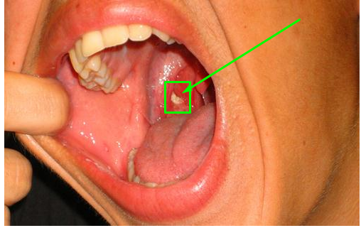 Penyebab Bau Mulut Tapi Sudah Gosok Gigi - SEBARKAN