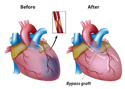 Coronary artery bypass graft surgery