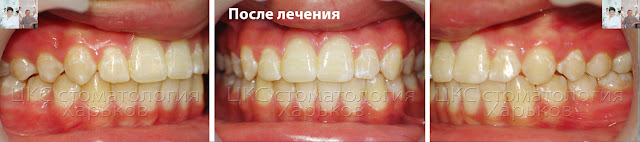 Прикус ребенка после ортодонтического лечения Ранее лечение брекетами, результат