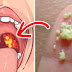 6 Alarming Symptoms Of Tonsilloliths That Should Never Be Ignored