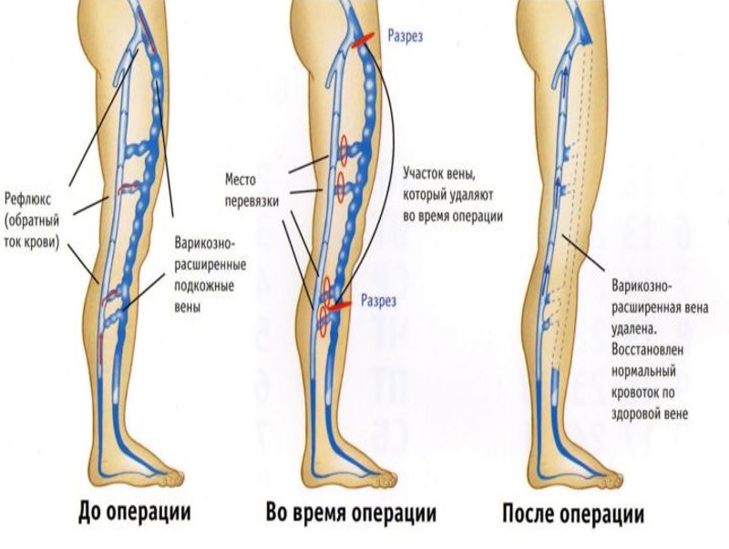 Варикозное Расширение Вен