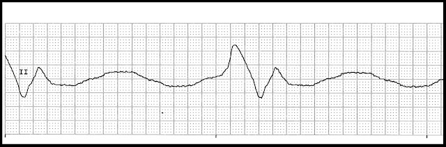 Float Nurse: Basic EKG Test 63