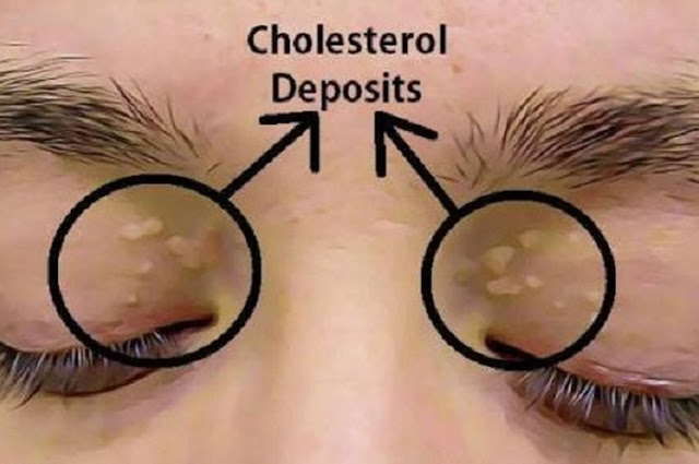 Ciri-ciri dan Tanda ini Ada Ditubuh Anda? Bisa Jadi Mengidap Kolesterol Tinggi