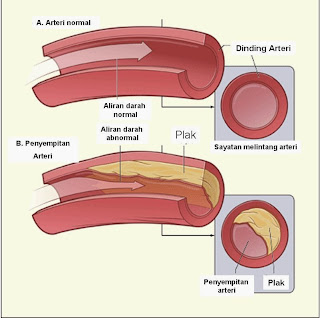 Apa itu Aterosklerosis dan Penyebab Arteriosklerosis | sorawrwr