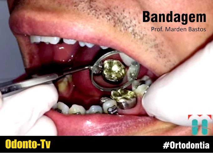 ORTODONTIA: Bandagem (Passo a Passo) - Prof. Marden Bastos