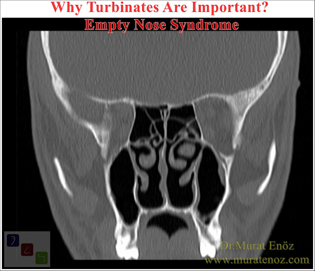 Why Turbinates Are Important? - Turbinates and Their Important Healt Related Jobs - Turbinate Hypertrophy - Symptoms of Turbinate Hypertrophy - Treatment of Turbinate Hypertrophy - Only Volume-Reducing Applications Are Recommended! - Empty Nose Syndrome - Intranasal Hyperventilation - Hyperventilation Syndrome