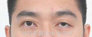 眼瞼下垂|提眼肌手術|兩眼無神|眼瞼下垂(提眼肌)手術案例分享 眼瞼下垂|提眼肌手術|兩眼無神|眼瞼下垂(提眼肌)手術案例分享