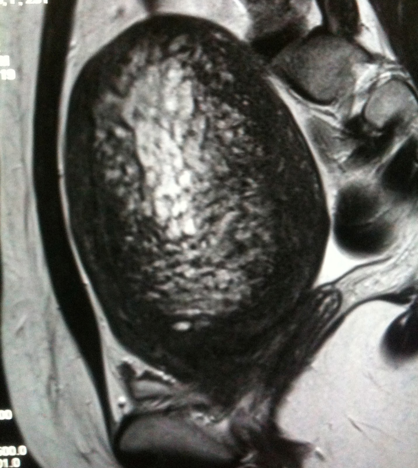 Endometrial Hyperplasia Versus Endometrial Cancer Sumer's Radiology Blog
