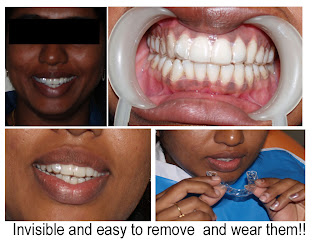 Invisible braces treatment