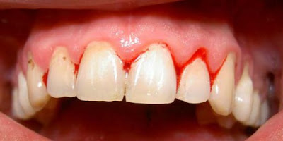 Cách khắc phục viêm nhiễm răng sau khi nhổ