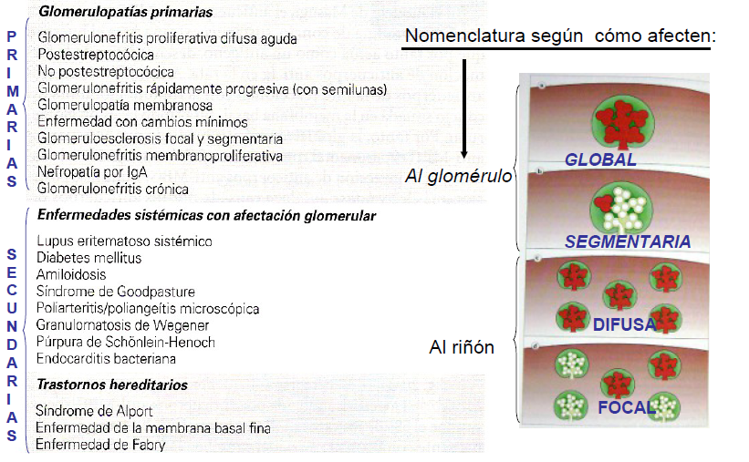 glomeruloesclerosis difusa tipo diabetes glomeruloesclerosis difusa tipo diabetes