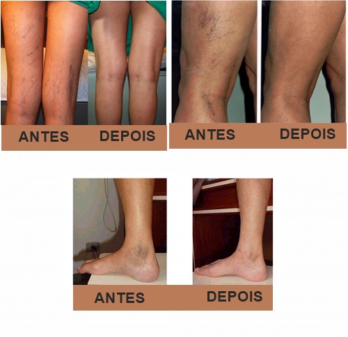 Pés a durante nos gravidez varizes