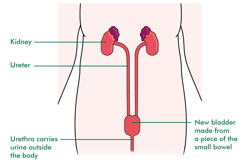 Urinary Elimination Urinary Diversion