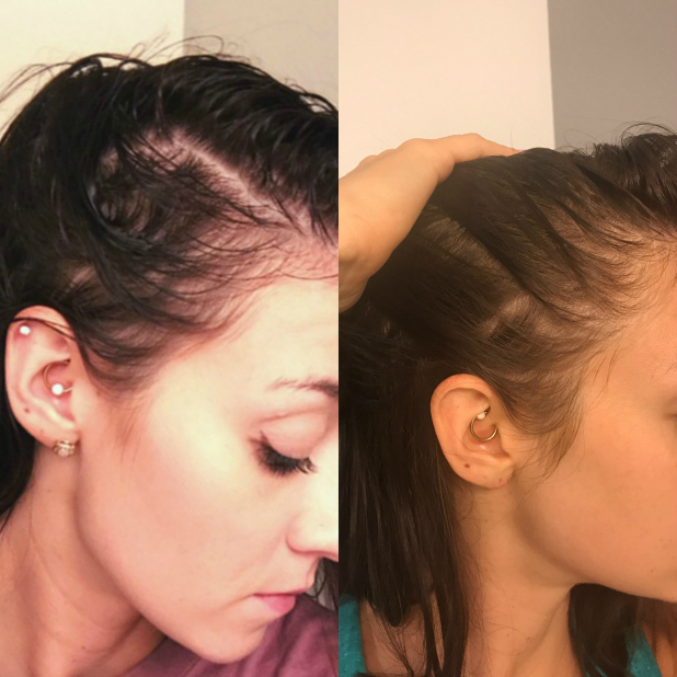 Telogen Effluvium & Hormonal Hair Loss/Thinning Update What Has Worked