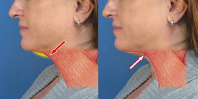 See How To Lose Weight In Your Neck Using These Tips See How To Lose Weight In Your Neck Using These Tips