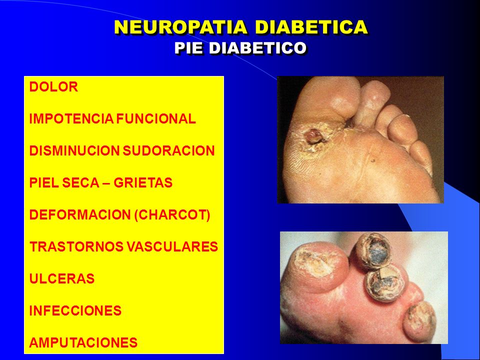 polineuropatia diabetica)