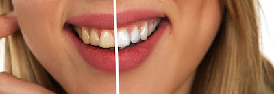 teeth whitening with baking soda