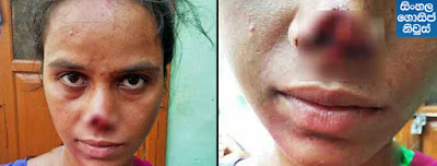 Indian husband Cuts Off Wife's Nose Because Her Family Couldn't Pay Her Dowry Indian husband Cuts Off Wife's Nose Because Her Family Couldn't Pay Her Dowry