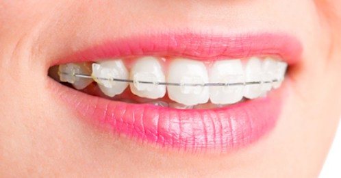  răng thừa mọc giữa 2 răng cửa