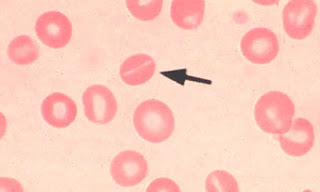 Stomatocytes Definition, Symptoms, Causes, Treatment