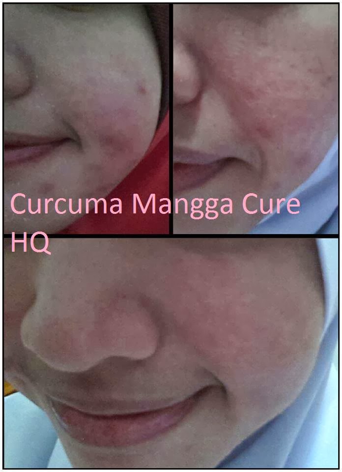 Curcuma Mangga Cure Felinna Beauty Murah  Roziez Shop