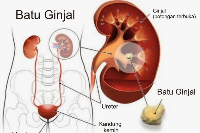 Mengeluarkan Batu Ginjal Tanpa Operasi
