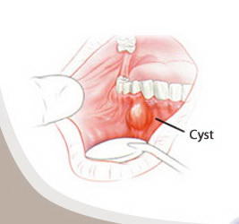 dental cyst