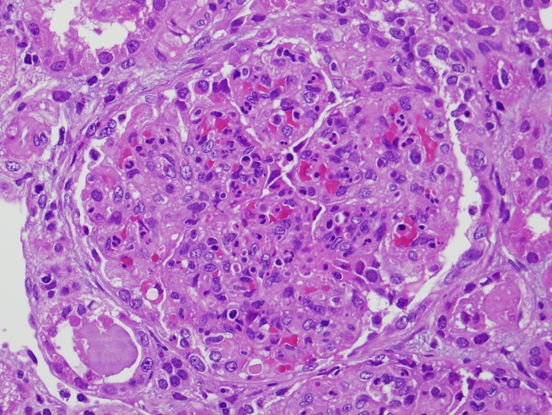 Renal Pathology Review Poststreptococcal glomerulonephritis and