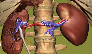 Diabetic Ketoacidosis: Analgesic Nephropathy - what Is Ketoacidosis