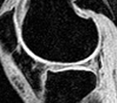 articular cartilage damage knee