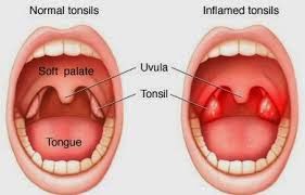 Tonsil Tongue Out Porn - Tonsil Amandel Pengertian Penyebab GejalaSexiezPix Web Porn
