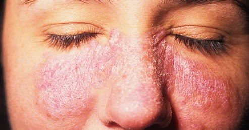 cold induced rash - Allergy - MedHelp