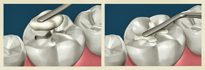 Quá trình trám răng mất thời gian bao lâu thì hoàn tất?