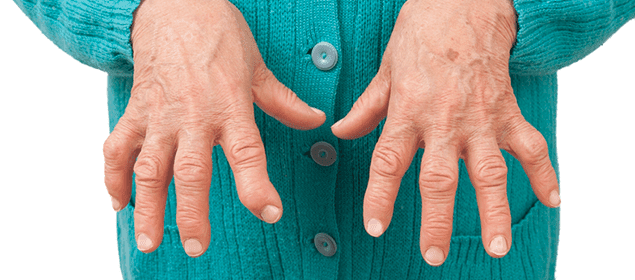 remedios para la artritis reumatoide