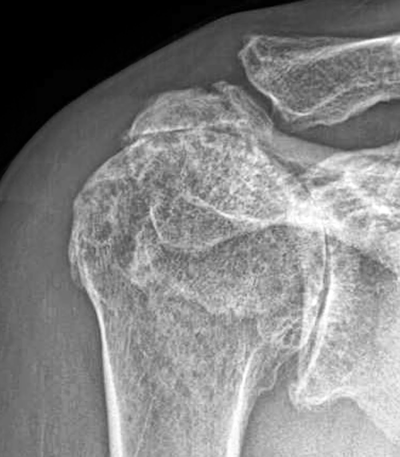 Shoulder Arthritis/Joint Replacement Rotator cuff tears The rotator