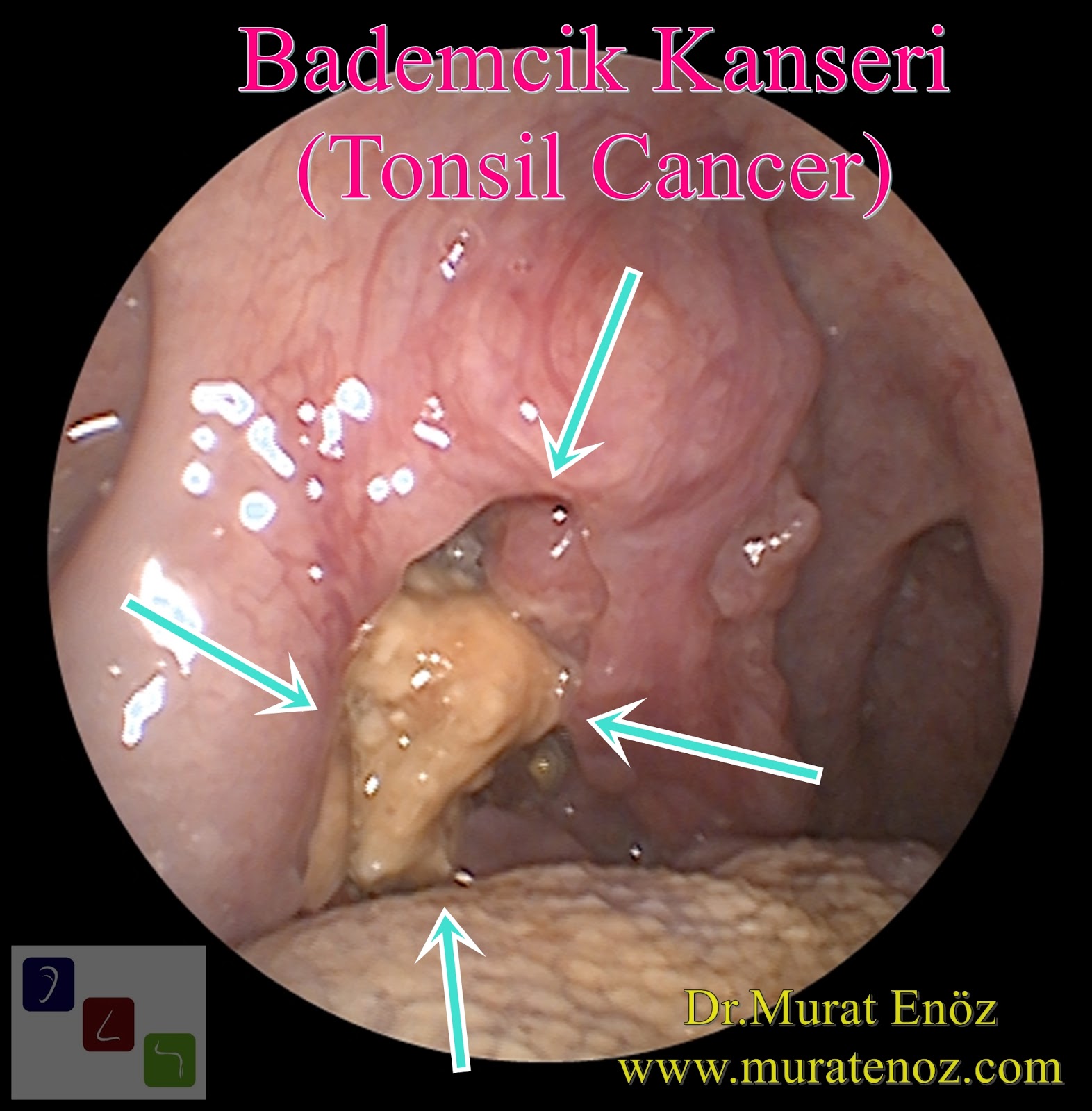 lingual tonsil cancer symptoms