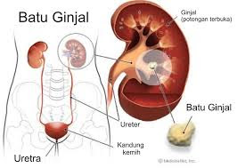 Cara Alami penanganan pada penderita batu ginjal