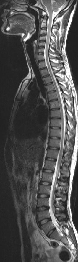 Dr Balaji Anvekar FRCR Atrophy Of Paraspinal Muscles causes-of-muscle-atrophy-on-one-side-of-the-head-in-dogs-vlog-34