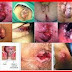 Obat Mujarab Buat Ambeien Parah thumbnail