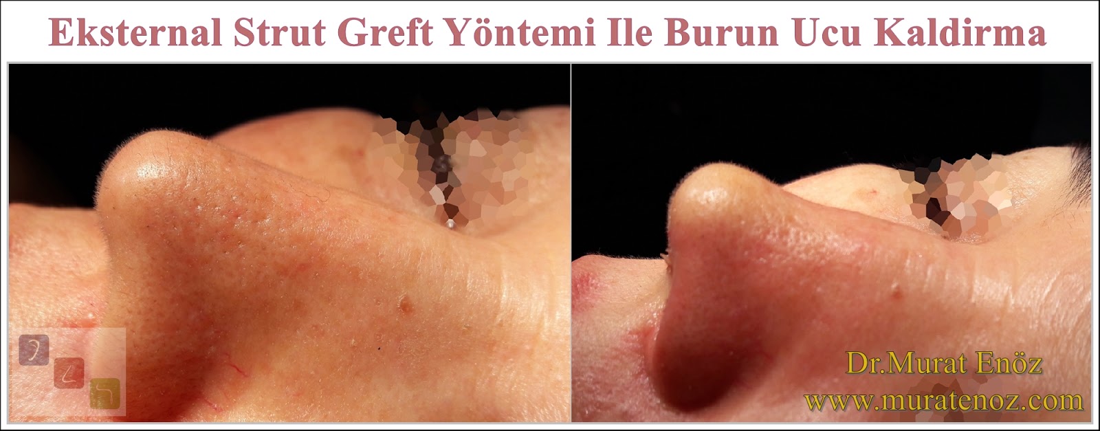 Eksternal Strut Greft Yöntemi İle Burun Ucu Kaldırma